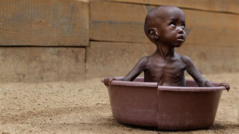 niños de africa desnutridos